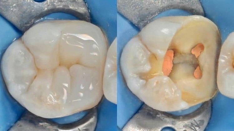 درمان ریشه دندان چیست و چرا انجام می‌شود؟
